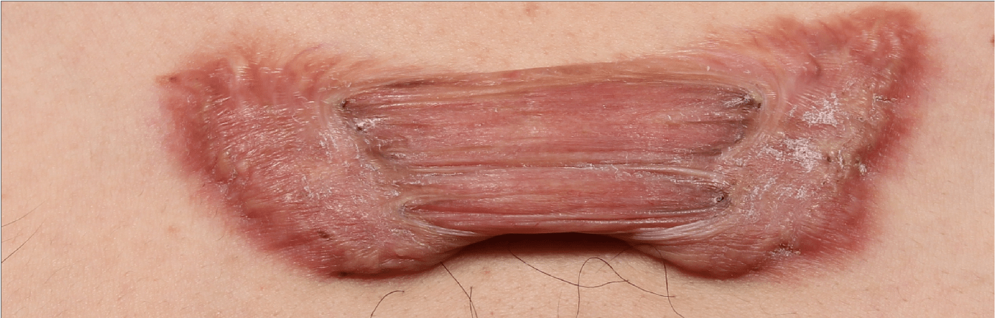 案例蟹足腫疤痕型態