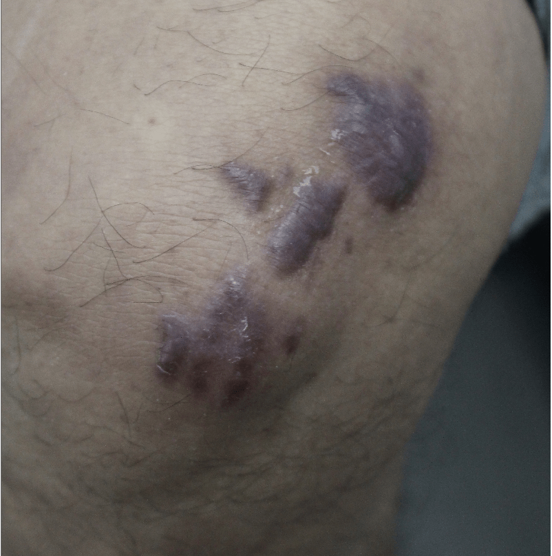 案例增生性疤痕型態