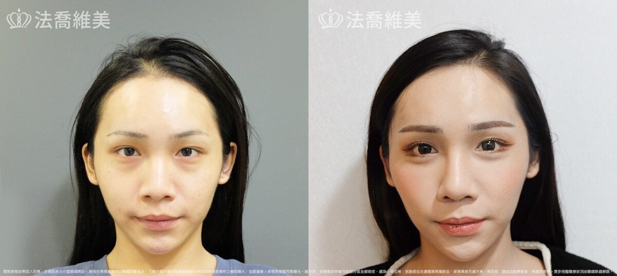 法喬醫美診所林日新醫師隆鼻