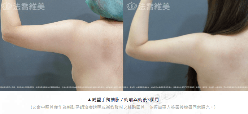 手臂抽脂 大方的穿上無袖上衣吧!