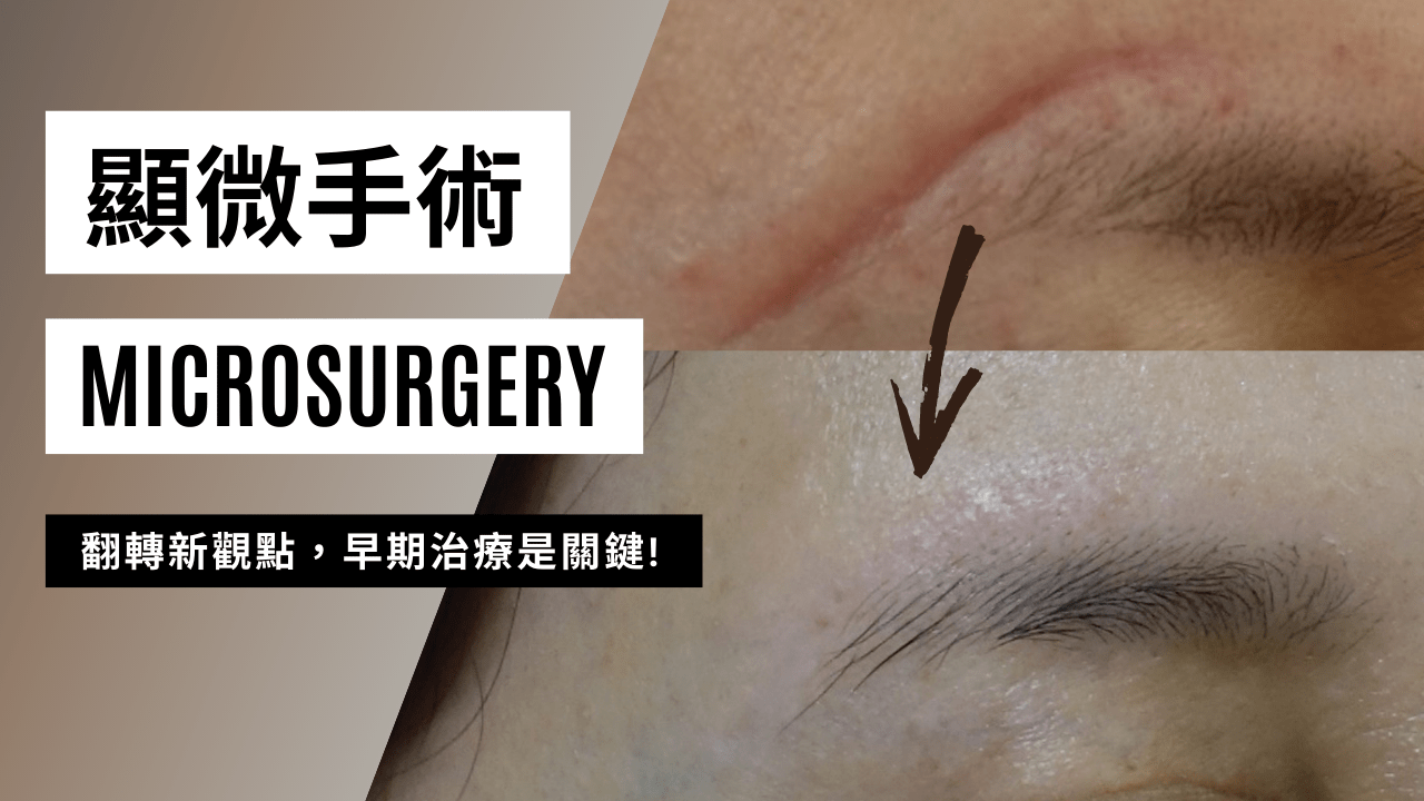 顯微手術治療疤痕