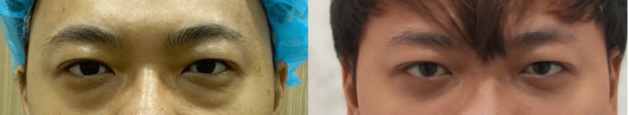 談眼袋內開加淚溝蘋果肌補脂手術的特點