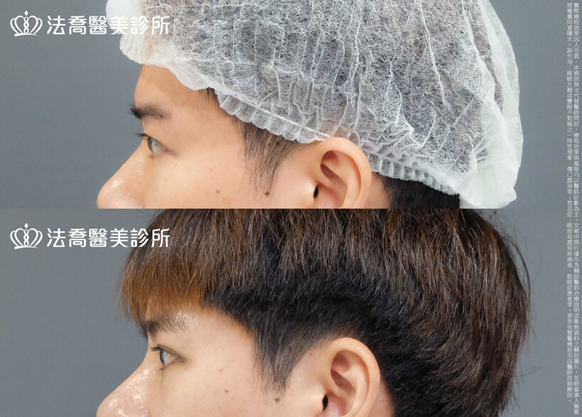 法喬醫美診所,邱浚彥,割雙眼皮