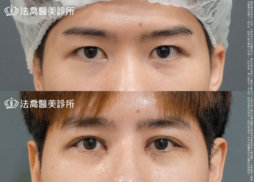 法喬醫美診所,邱浚彥,割雙眼皮
