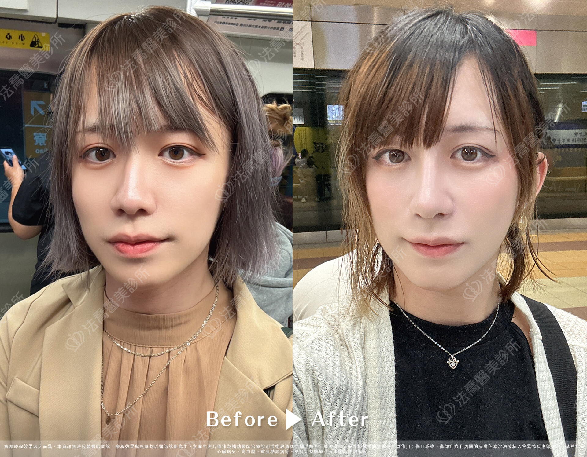 自體肋骨隆鼻、異體真皮墊眉心、縮鼻翼