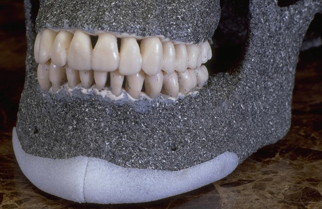 人工骨墊下巴模型