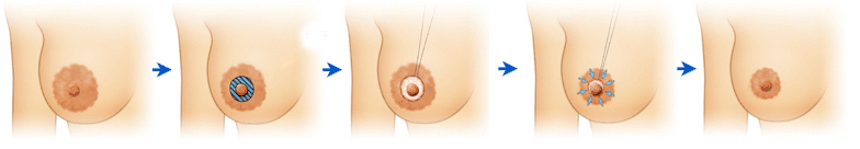 修乳暈手術方式