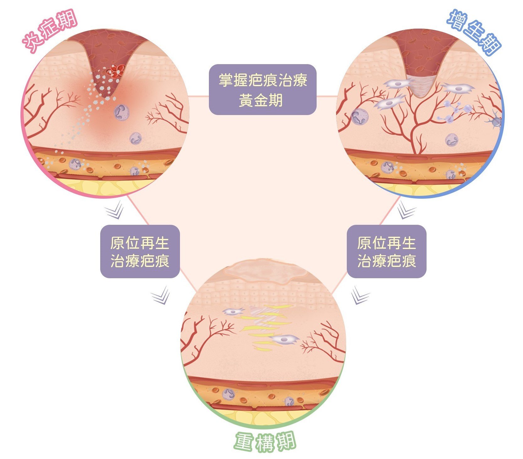 疤痕階段治療黃金期