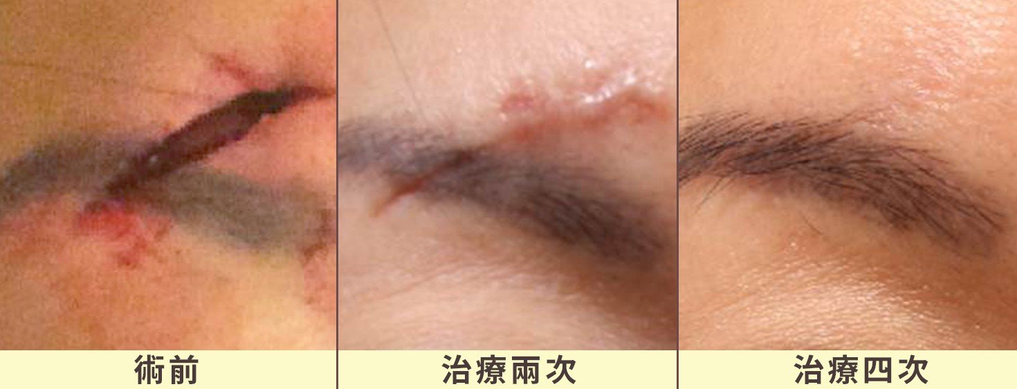 眉毛外傷疤痕治療