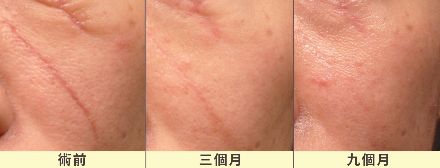臉部撕裂傷疤痕治療