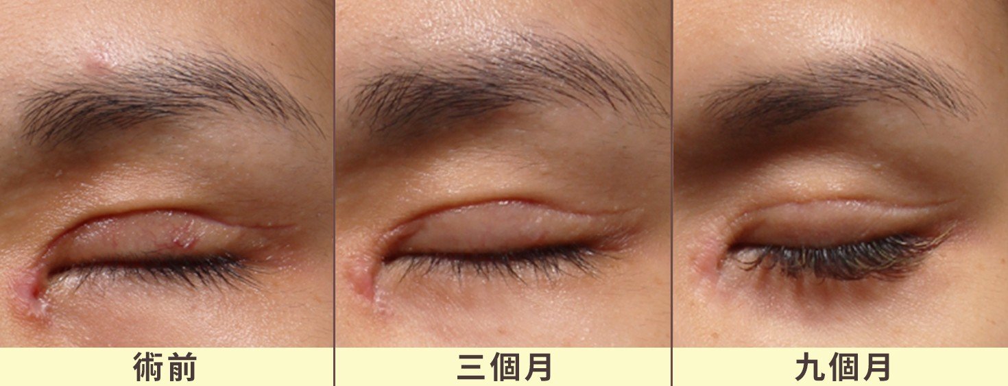 雙眼皮增生性疤痕治療