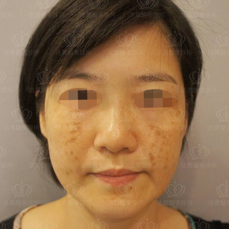 淨膚雷射前
