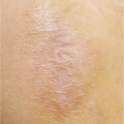 增生性疤痕案例術後