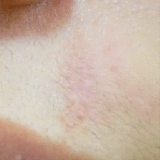 白色疤痕術後案例1