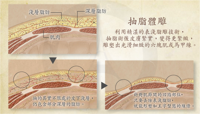 抽脂體雕原理