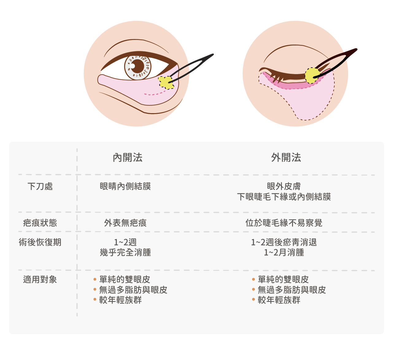 眼袋外開vs眼袋內開
