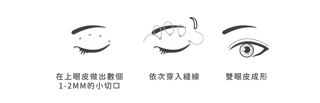 縫雙眼皮手術方式