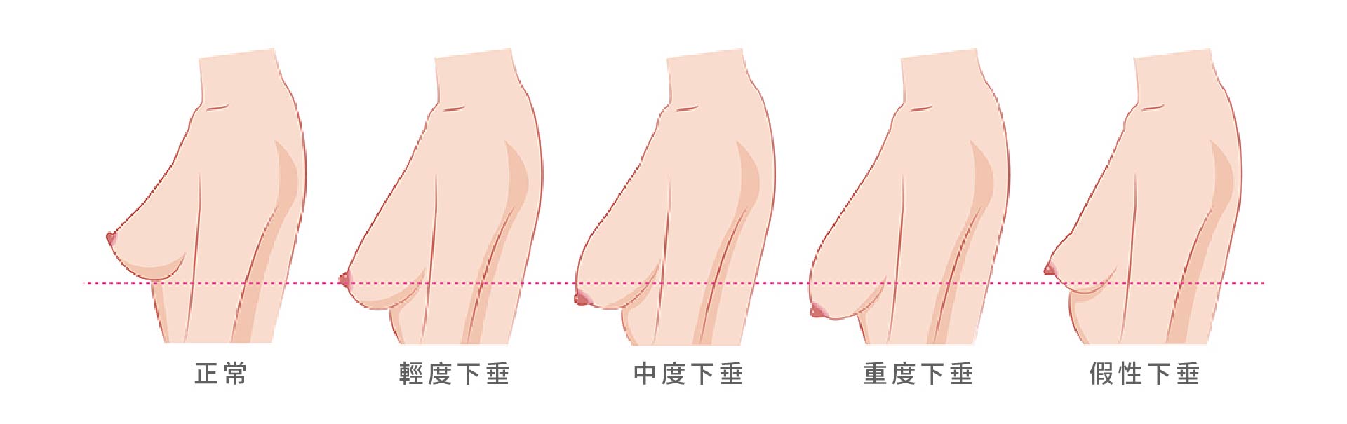 乳房下垂嚴重度