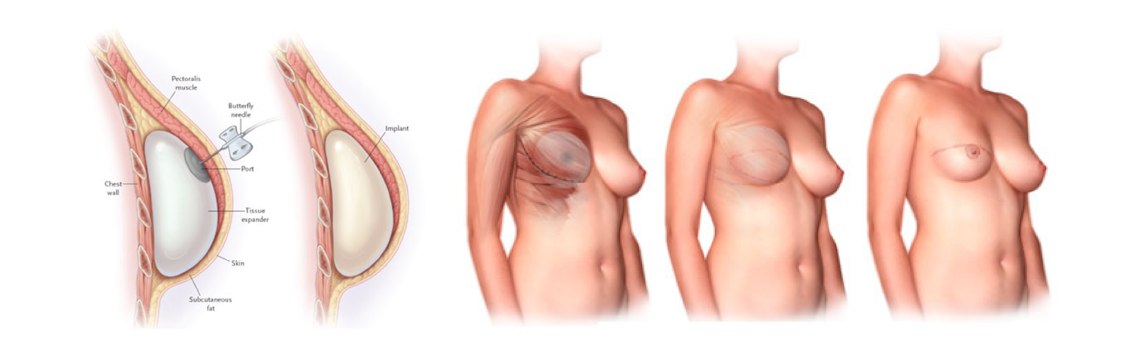 外來植入物重建手術