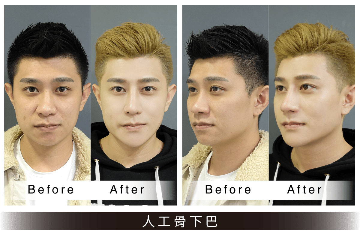 人工骨墊下巴案例