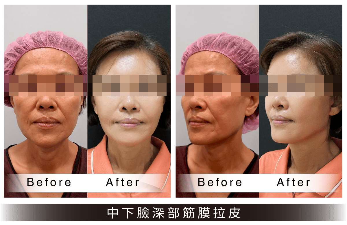 中下臉深部筋膜拉皮前後比對