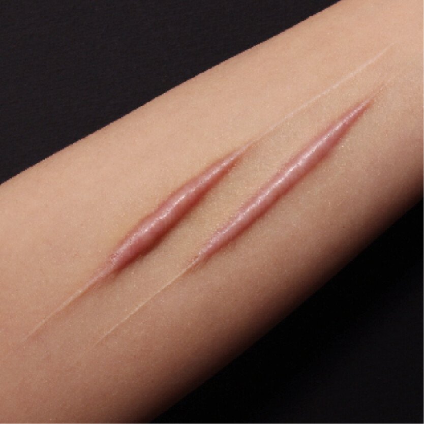 增生性疤痕案例