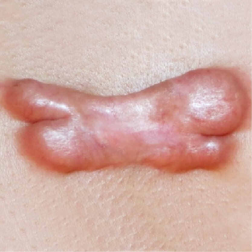 肥厚性疤痕案例