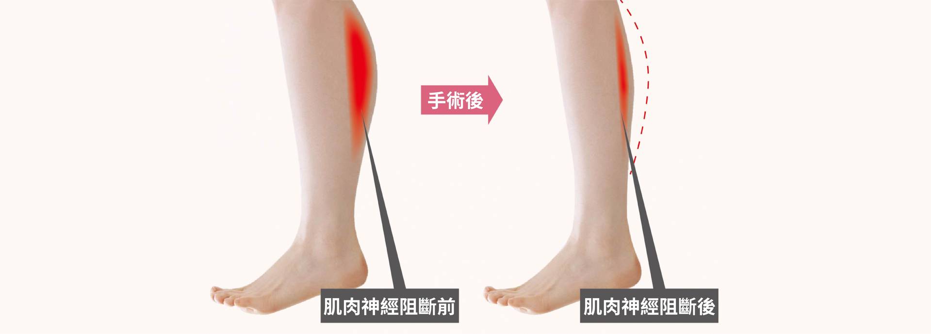 小腿神經截斷原理