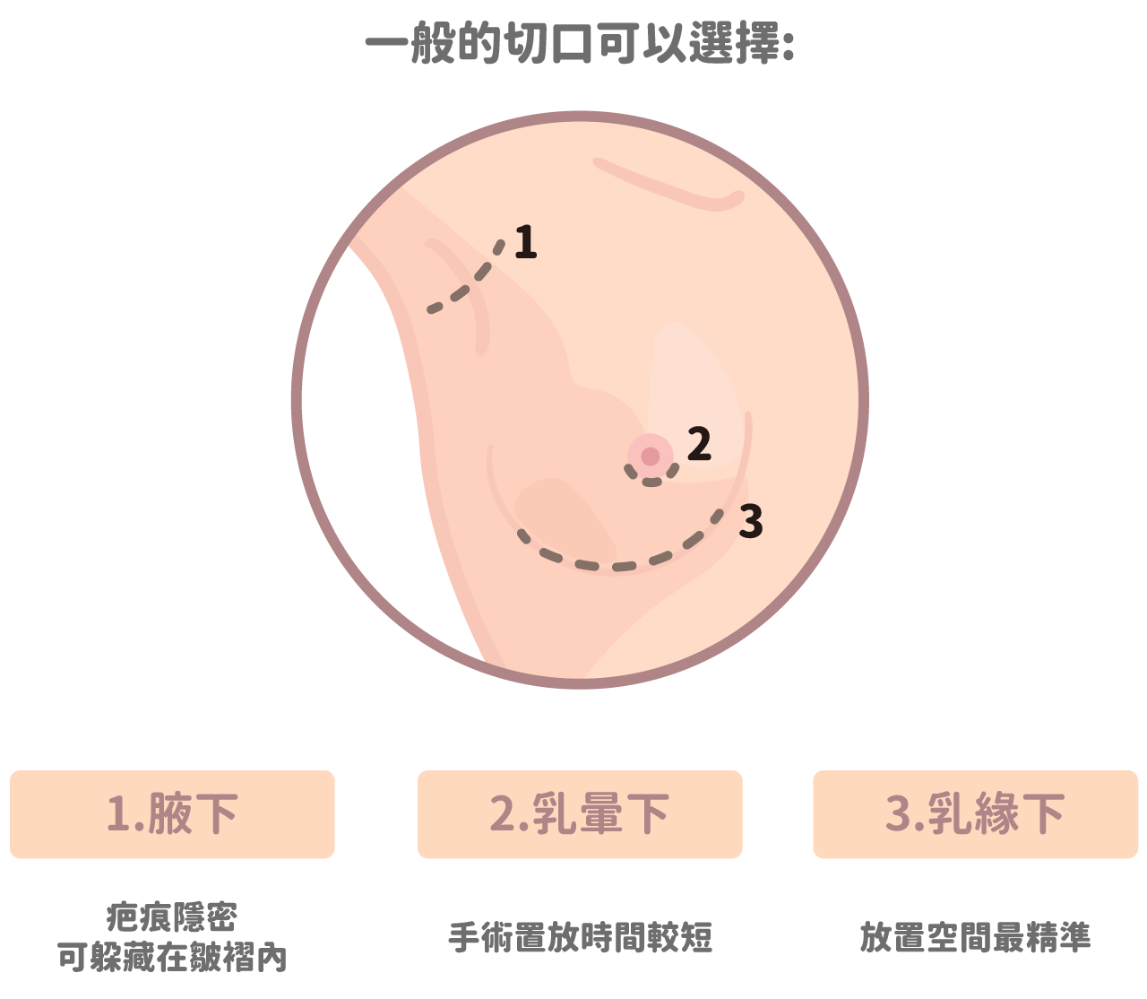 胸部手術切口介紹