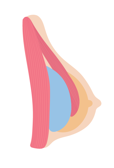 胸部植入物置於胸大肌下