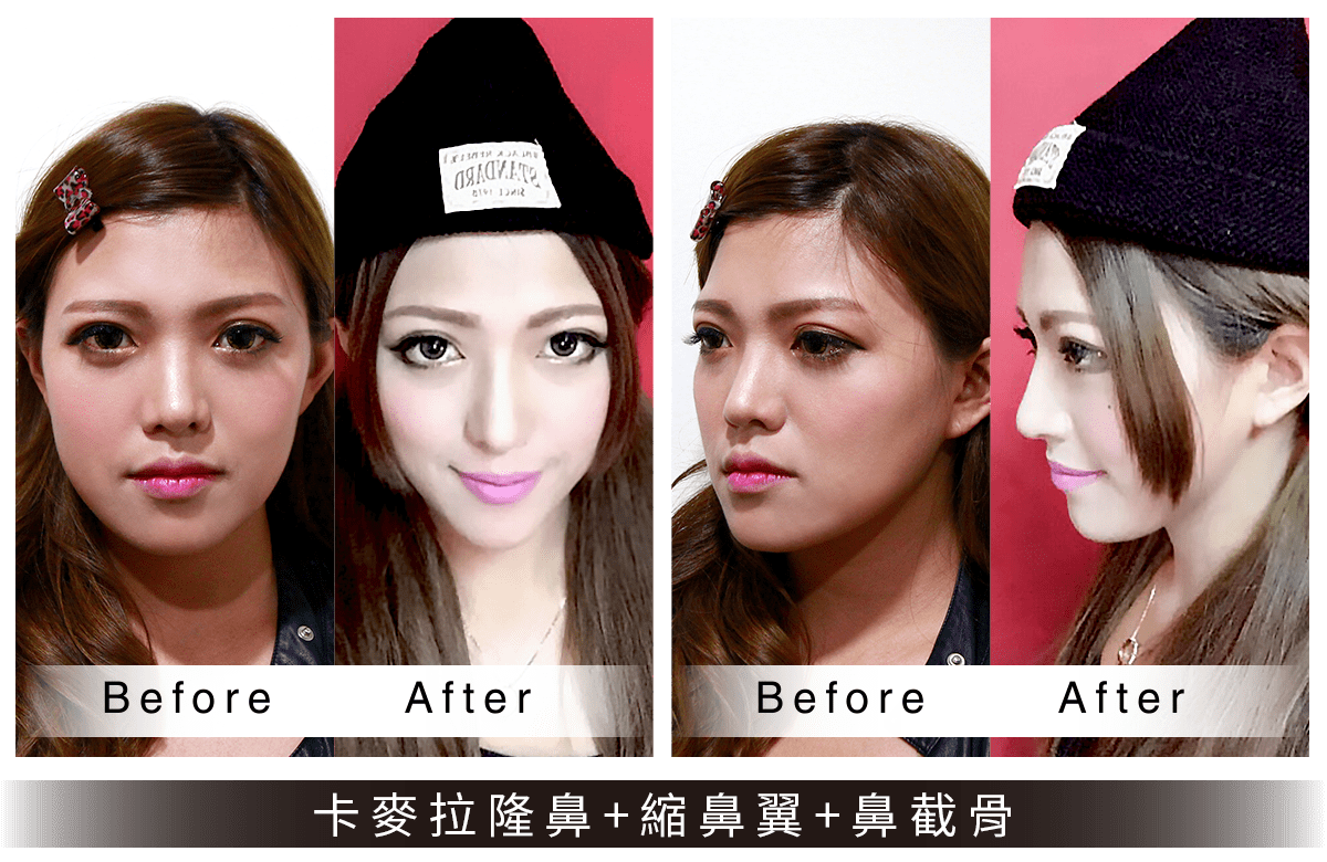 卡麥拉隆鼻/縮鼻翼案例
