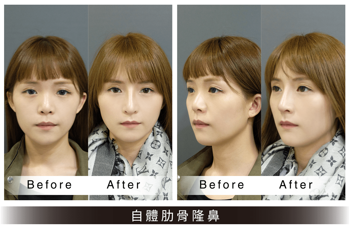 自體肋骨隆鼻術案例
