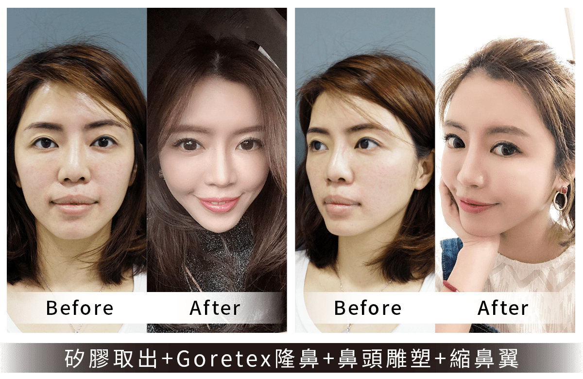 Goretex隆鼻(矽膠取出)案例