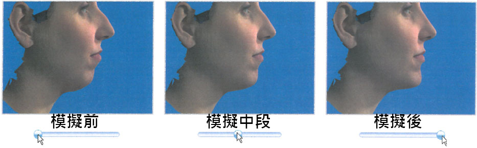 模擬鼻部及下巴整形