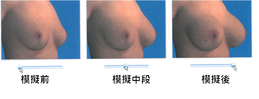 模擬胸部整形