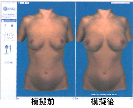 模擬胸部整形