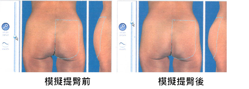 模擬提臀手術