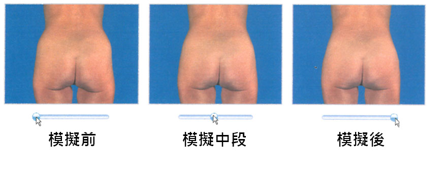 模擬抽脂雕塑手術