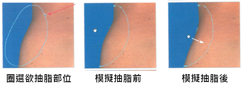 模擬抽脂雕塑手術