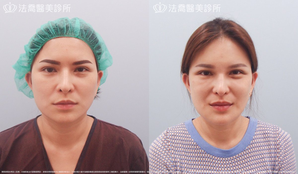 法喬醫美診所,邱浚彥,人工骨下巴