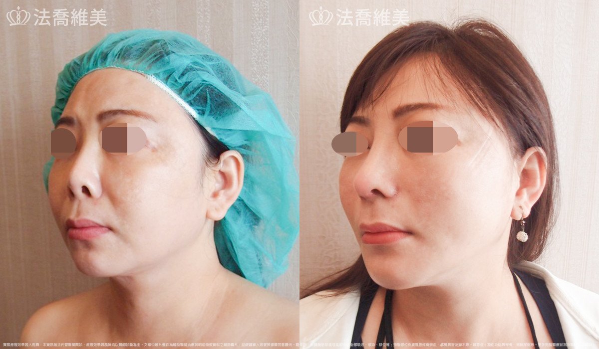 法喬醫美診所,邱浚彥,自體肋骨隆鼻
