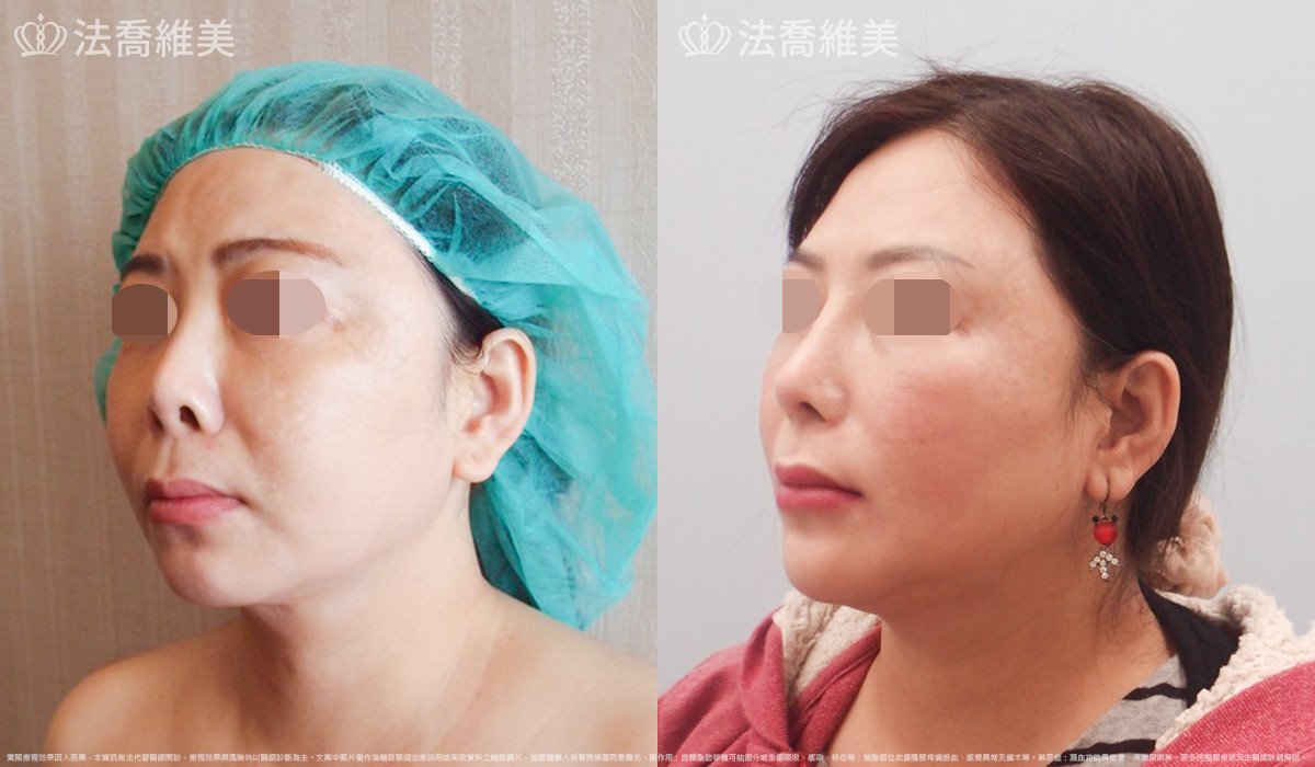 法喬醫美診所,邱浚彥,自體肋骨隆鼻