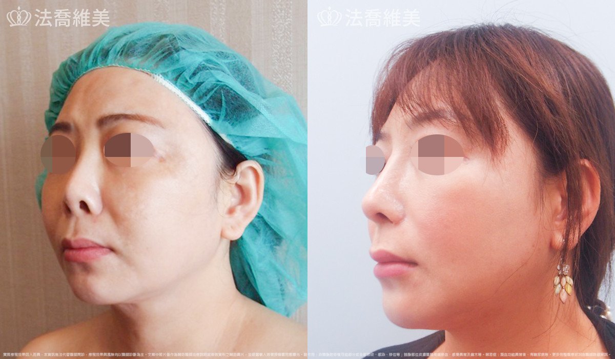 法喬醫美診所,邱浚彥,自體肋骨隆鼻