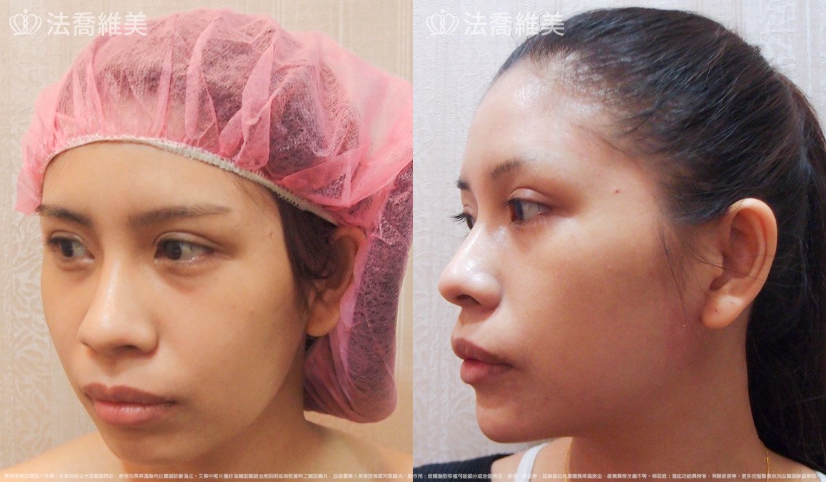 法喬醫美診所,邱浚彥,人工骨下巴