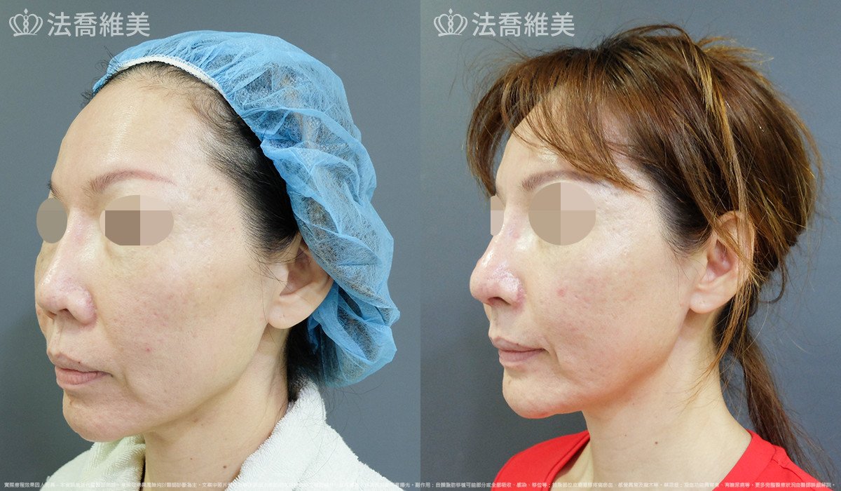 人工骨下巴,法喬醫美診所,邱浚彥