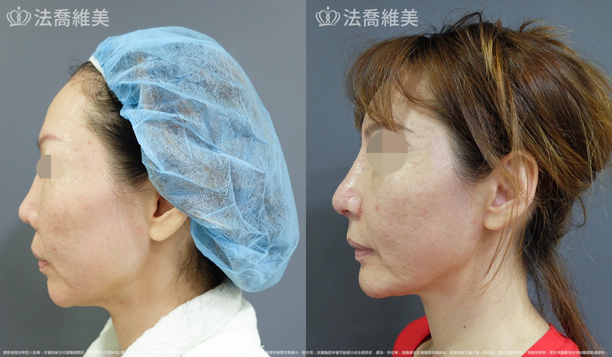 人工骨下巴,法喬醫美診所,邱浚彥