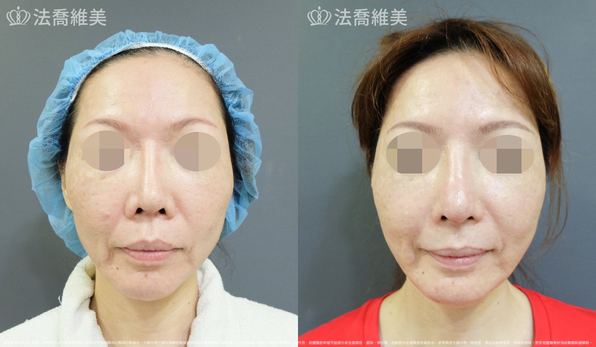 人工骨下巴,法喬醫美診所,邱浚彥