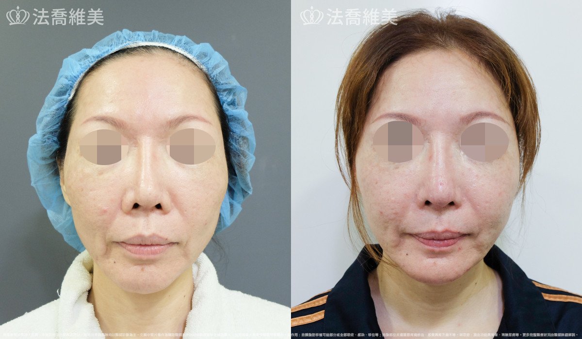 人工骨下巴,法喬醫美診所,邱浚彥