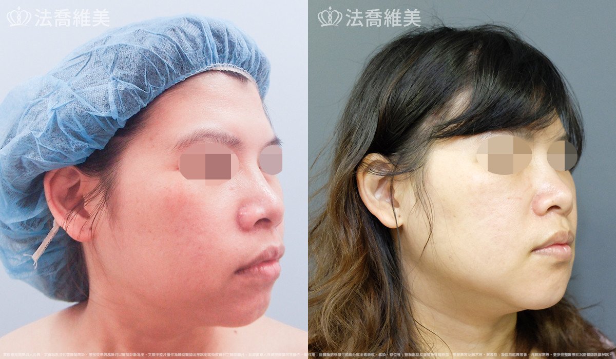 人工骨下巴,法喬醫美診所,邱浚彥