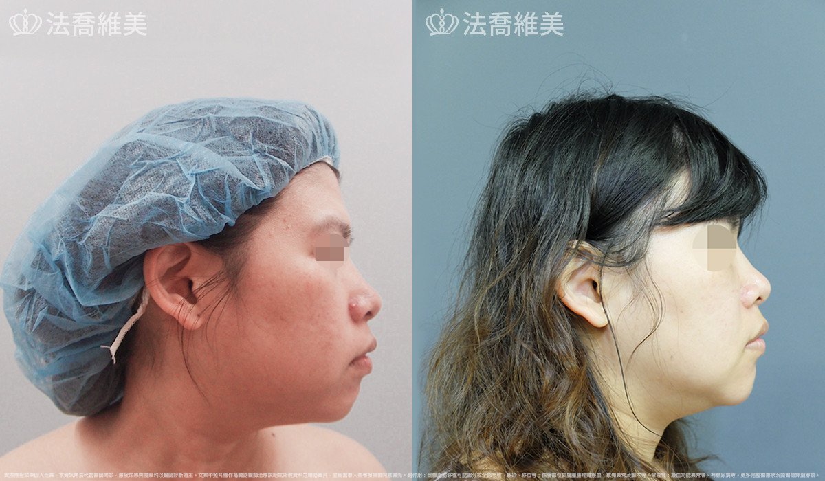 人工骨下巴,法喬醫美診所,邱浚彥